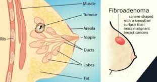 Fibroadenomat, kanceri beninj i gjoksit, si duhet ndjekur dhe trajtuar
