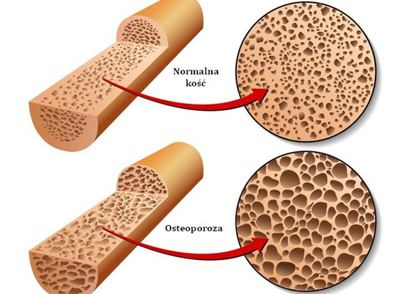 Si të parandalojmë osteoporozën nëpërmjet ushqimeve